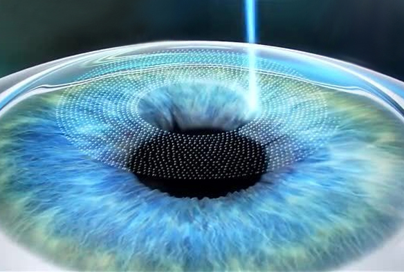 激光(guāng)手術(shù)